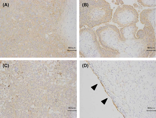 Fig. 5. Immunohistochemical staining using KM3953 for ovarian carcinomas and normal ovary tissue.