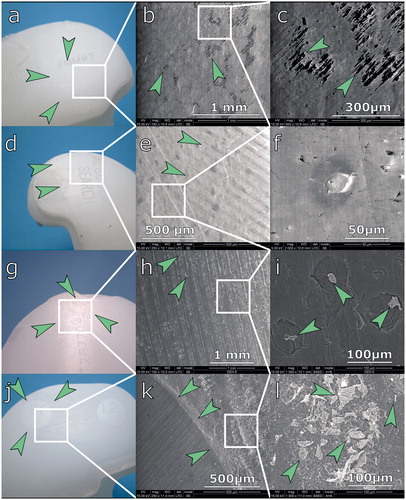 Figure 4. Analysis of backside wear using optical microscopy (left) and scanning electron microscopy (right). a. Arrows indicate dimpling seen in the Triathlon inlay. b. Triathlon knee, low-magnification SEM. Arrows indicate loss of machining marks. c. Triathlon knee, high-magnification SEM. There are no PE particles visible; arrows indicate partially preserved machining marks. d. Flattening (arrows) of machining marks on the Search inlay. e. Search inlay, low-magnification SEM. Arrows indicate loss of machining marks. f. Search inlay, high-magnification SEM. PE flattening (arrows); no particles visible. g. Genesis II inlay. Arrows indicate flattening of machining marks. h. Genesis II, low-magnification SEM. Flattening of machining marks; arrows indicate craters. i. Genesis II, high-magnification SEM image. Arrows indicate PE debris visible within craters. j. NexGen knee. Unworn PE within screw holes of the tibial tray (arrows) and material abrasion around it. k. NexGen knee, low-magnification SEM. Abrasion grooves and border (arrows) of unworn material. l. multiple wear debris seen within abrasion grooves (indicated by arrows).