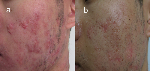 Figure 2 Comparison of the cases in combination therapy before and after treatment in Pt 6. (a) Lesion before treatment. (b) Lesion after three ALA-PDT combined with two intralesional injection treatments.