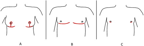 Figure 1. Mastectomy scar patterns. (A) Scars from a Wise-pattern reduction. (B) Scars from a double-incision mastectomy with free nipple grafts. (C) Scars from a periareolar mastectomy.