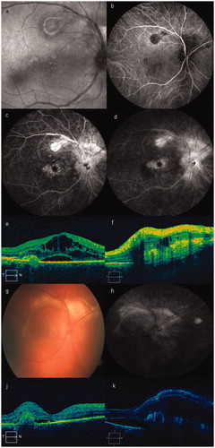 Figure 1. (a) Red-free photo of the right eye on presentation. (b) Baseline visit. Indocyanine green angiography depicting the choroidal lesions. (c, d) Baseline visit. Fluorescein angiography (early and late phase), showing multiple RPE lesions, optic nerve, and macular edema. (e) Baseline visit. Optical coherence tomography (OCT) scan of the fovea showing macular edema and subretinal and intraretinal fluid. (f) Baseline visit. OCT scan to the upper part of the optic nerve, revealing significant fibrosis and subretinal fluid. (g) Follow-up color photo of our patient, 1 year after initial diagnosis. (h) One-year follow-up visit. Fluorescein angiography late phase, showing that the fibrotic lesions had expanded and coalesced. (j) One-year follow-up visit. OCT scan depicting macular edema and fibrosis. (k) One-year follow-up visit. OCT scan 2 years following diagnosis revealing deterioration with persisting macular edema and fibrosis.