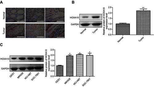 Figure 1 The expression of HOXA10 was increased in gastric cancer tissues and cells. (A) The expression of HOXA10 protein in 20 matched gastric cancer tissues and the normal tissues was detected by IHC, and 3 images were shown (scale bar=100 μm). (B) The expression of HOXA10 protein in 20 matched gastric cancer tissues and the normal tissues was detected by Western blotting, and the most representative images were shown. (C) Western blotting analysis of the HOXA10 protein levels in normal gastric cell line GES 1 and gastric cancer cell lines NCI-N87, MKN28 and SGC-7901. (*P<0.05, **P<0.01).