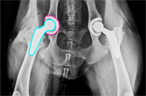 Figure 5 Radiograph illustrating a bilateral total hip replacement.
