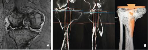 Figure 2 (A) T2-weighted coronal MRI depicting soft tissue at the right knee and indicating isolated osteoarthritis on the lateral side. (B) TKA implant templating process revealed inadequate viable bone stock that would be unable to support an implant.