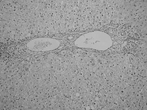 Figure 1. Liver biopy showing primary biliary cirrhosis.