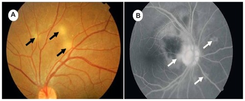 Figure 1 (A) Ophthalmoscopic pictures showing multiple choroidal tubercles (black arrows); (B) choroidal tubercles (white arrows): fluorescein angiogram.