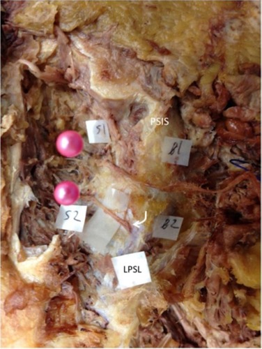 Figure 2 Photograph showing MCN branches traversing over and under the LPSL on the left side in a cadaveric specimen obtained from an 88-year-old woman (specimen no. 21).