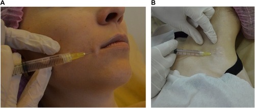 Figure 6 Patient L. intradermal injections in the macules on the face (A) and the neck (B).