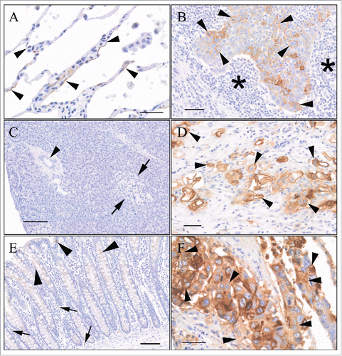 Figure 4. Binding specificity of 2G12–2B2 on human TMAs. (A) Normal (non-neoplastic) lung: There was lumen membrane staining of rare alveolar lining cells (arrowheads). Image is from a region with more frequent staining. Bar = 40 μm. (B) Lung squamous cell carcinoma: Membrane staining of neoplastic epithelial cells (arrowheads). Asterisks indicates mononuclear inflammatory cell infiltrate around neoplastic cell infiltrate. Bar = 100 µm. (C) Normal (non-neoplastic) pancreas: There was no staining of any tissue elements. Arrows = islet of Langerhans. Arrowhead = Pancreatic ductule. Bar = 100 µm. (D) Pancreatic ductal adenocarcinoma: Moderate to intense staining of neoplastic cells infiltrating into adjacent stroma. Bar = 50 µm. (E) Normal (non-neoplastic) colon: Cytoplasmic staining of goblet cells (arrowheads). Cytoplasmic +/− membrane staining of scattered endothelial cells. Bar = 100 μm. (F) Ascending colon adenocarcinoma, moderately differentiated: Frequent membrane and staining of neoplastic epithelial cells (arrowheads). Cytoplasmic staining also present. Bar = 40 μm.