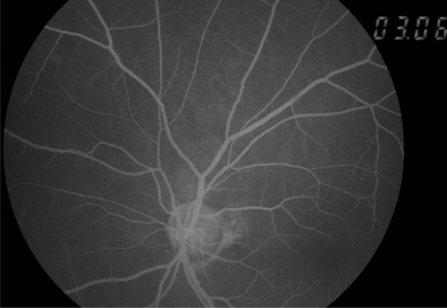 Figure 2 Fluorescein blockage specific to retinal hemorrhage was not shown in fluorescein angiography.