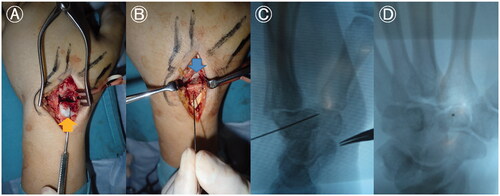 Figure 3. Intraoperative findings in an isolated left trapezoid coronal shearing fracture in a 40-year-old male. (A) The dorsal fragment (arrow) has been inverted to remove the hematoma, small bone fragments, and granulation tissue, that were inhibiting reduction. (B) Reduction is achieved by pushing the dorsal bone fragment toward the volar bone fragment while pulling the index and middle fingers. Guide pins are inserted, and the joint surface of the second carpometacarpal joint is inspected to ensure ideal reduction (arrow). (C) Reduction is confirmed under fluoroscopy. (D) The trajectory of the guide pin is confirmed under fluoroscopy.