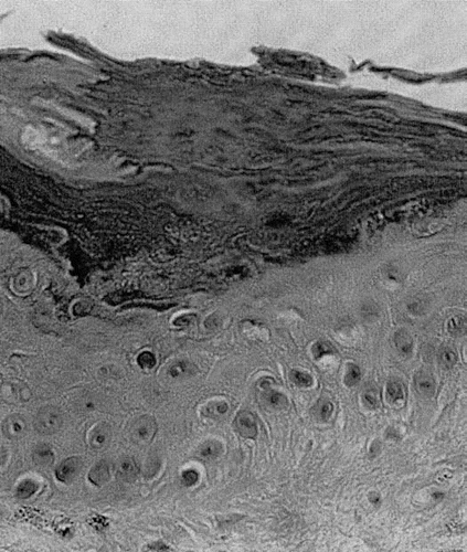 Figure 2 Column of parakeratotic cells contained in invagination of epidermis and thinning of the granular layer, cornoid lamellae (Hematoxylin-eosin stain).
