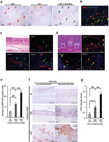 Figure 1. CAFs present in esophageal cancer tissue increase with tumor invasion depth. (a) Immunohistochemistry of an advanced case of resected esophageal squamous cell carcinoma (ESCC), in which large numbers of CAFs are located in the tumor stroma. SMA positive cells are (red arrowheads) observed both in the tumor stroma (CAFs) and at the layer of the lamina propria (red arrowheads). FAP-positive cells (orange arrowheads) are observed only in the tumor stroma (CAFs). FSP-1 positive cells (green arrowheads) are observed in the tumor stroma (CAFs) but also the stroma of the lamina propria, which is not tumor area. Scale bar, 200 μm (x100). (b–d) Microscopy shows HE and immunofluorescent (IF) double staining of αSMA and FSP1 labeled with Alexa568 (red) and Alexa488 (green), respectively. Green cells indicate normal fibroblasts, and yellow/orange cells indicate CAFs. Red cells indicate smooth muscle cells. Colored arrowheads highlight examples of these different cells in the tumor microenvironment. The nuclei were counterstained with DAPI (blue). Scale bar, 500 μm (HE), 50 μm (IF). (b) The complexity of the presence of different stromal cells is shown by IF. The dotted white line shows the tumor’s invasive front. (c) A representative early case (with submucosal [SM] invasive depth) shows several green cells (normal fibroblasts) and red cells/structures (smooth muscle layers and vessels). For CAF quantitation, three zones of the tumor invasive front for each sample were selected and the results averaged. (d) A representative advanced case (with muscularis propria [MP] invasive depth) shows several orange/yellow cells, indicating accumulation of CAFs. (e) The mean number of CAFs (±SEM) was calculated for each invasive depth (mucosa [M], n = 8; SM, n = 8; MP, n = 8); ** P< .005, one-way ANOVA with Tukey’s test. (f) IHC of FAP staining. Scale bar, 1 mm (40x), 200 μm (200x). A representative M tumor shows low FAP intensity in the tumor and its surrounding stroma. A representative SM tumor shows moderate FAP intensity in the stroma. A representative MP tumor shows strong FAP intensity in the stroma. (g) The mean score of FAP intensity (±SEM) was calculated for each invasive depth; ** P< .005, one-way ANOVA with Tukey’s test.