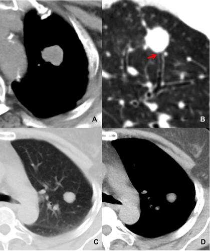Figure 3 Differentiation between pSCLC and benign lung tumors (pBLT). Axial and reconstructed CT images in a 69 year old female with pSCLC show an oval nodule with a smooth margin, homogeneous density (A) and bronchial cutoff sign (red arrow) (B). Axial CT images in a 51 year old female with pBLT show a round nodule with smooth margin (C), and homogeneous density (D).