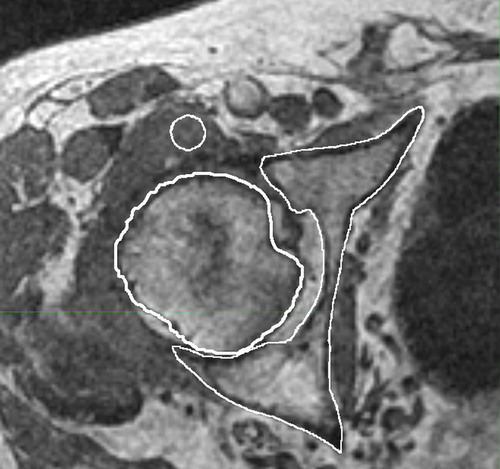 Figure 1. Example of a small normalization ROI (upper white circle) chosen within a muscle that is located next to the bone. The edge of the bone (lower white contour) is clearly visible enabling segmentation of the bone edge in the MR image (LAVA Flex® in-phase image).