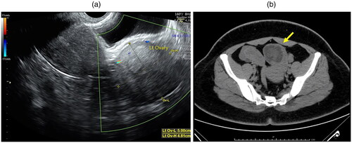 Figure 2. (a) Ultrasonographic appearance of left ovarian hyperechoic mass sized 5 × 5 cm. (b) Computed tomography of abdomen shows an enhancing lesion (7.8 × 5.2 × 4.8 cm) with contained 5.8 × 4.7 × 4.5-cm well-defined enhancing fatty mass without calcification likely arising from the left ovary (arrow).