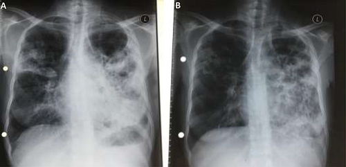 Figure 2 Plain film chest radiographs for patient two - Postero-Anterior view: (A) September 2020, showing extensive bilateral infiltration and cavitation, involving the left lung more extensively than the right, with left upper lobe bullous lesion (B) March 2021, showing fibrosis of the right upper lobe with residual cavities, and fibro-cavitary changes involving of the left lung.