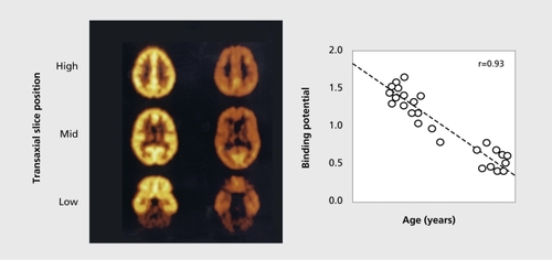 Figure 1. [18F]Altanserin positron emission tomography (PET) imaging of the 5-hydroxytryptamine (serotonin) type-2A receptor (5-HT2A). Left. [18F]Altanserin PET images (summed over 20 to 90 min postinjection and displayed with scale normalized to cerebellum) at three brain levels in healthy subjects, aged 20 (left) and 66 (right). Right. Scatter plot demonstrates a linear decline in the binding of [18F]altanserin to 5-HT2A receptors in the lateral orbitofrontal cortex over the adult life span.