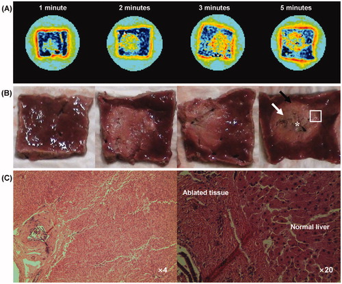 Figure 7. (A) Colour-coded conductivity images at the RF power of 70 W for 1, 2, 3 and 5 min of exposure time, respectively. (B) Photography shows the cross-section of ablated liver tissue at the corresponding conductivity imaging slice. The arrows indicate the carbonisation (asterisk), coagulation necrosis (white arrow) and the hyperaemic rim (black arrow). (C) Microscopic findings of ablated liver tissue obtained from the rectangle region (H&E stain, ×4 and ×20).