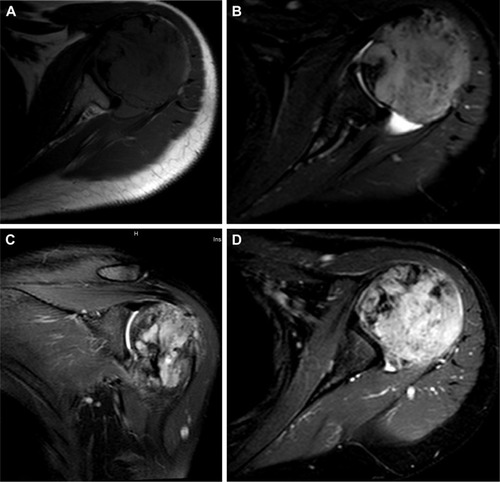 Figure 2 MRI images of this patient. (A) The lesion presented low signal on T1 sequence; (B) the lesion presented a relatively high signal than the adjacent muscle but a weaker signal than liquid on T2-sequencing images; (C) coronal section of the MRI image showed the lesion presented mixed signals on T2 sequence; and (D) a cross-section of the MRI image on T1 sequencing reveals a lesion with a slight enhancement.