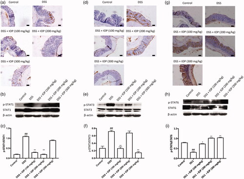 Figure 6. Effect of IOP on the activation JAK-STAT signalling pathway in colon tissue examined with immunohistochemical and western blot. (a–c) STAT1 and p-STAT1 expression in colon tissue. (d–f) STAT3 and p-STAT3 activation of colon tissue. (g–i) STAT6 and p-STAT6 activation of colon tissue. *p < .05, **p < .01 compared with model group; microphotographs were taken at ×20 magnification; bars = 50 µm. #p < .05, #p < .01 compared with control group.