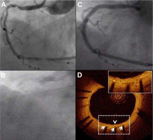 Figure 4 Coronary angiography and optical coherence tomography (OCT) 9 months after Promus Element implantation. A diffusely diseased right coronary artery (A) was treated with three slightly overlapping Promus Element stents. Panel (B) confirms excellent radiopacity of the Platinum Chromium Element stent platform. Follow-up angiography at 9 months shows prolonged vessel patency (C). A representative OCT image confirms favorable healing: all struts (white arrows) are covered with a thin homogeneous layer of neointimal tissue (arrowhead) with a well-preserved lumen area (D).