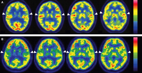 Figure 2. Transaxial PET images of each participant's brain: activation (arrowheads) of the superior temporal gyrus with visual language stimuli in each case. (A) Case 1 (GJB2 mutation). The superior temporal gyri were strongly activated bilaterally. (B) Case 2 (SLC26A4 mutation). The superior temporal gyri exhibited less activation than in case 1.