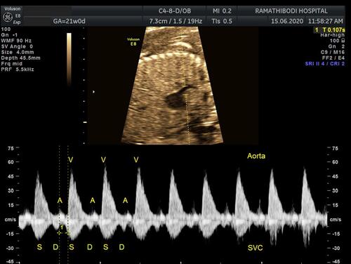 Figure 2 Pulsed wave Doppler image of superior vena cava-aorta (SVC-Ao) obtained from sagittal plane, time between SVC atrial wave onset and the beginning of aortic ejection flow represents mechanical PR interval.