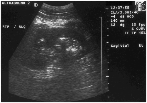 Figure 3. Ultrasound performed 24 h post transplant showing multiple parenchymal stones.