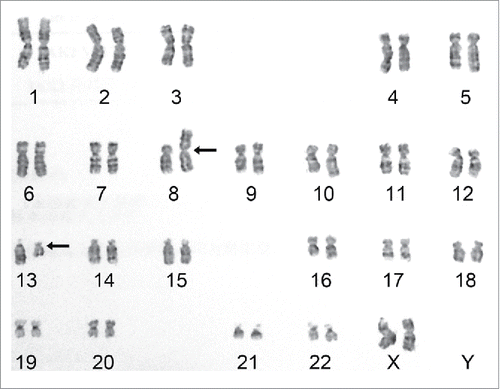 Figure 2. Karyotype shows a chromosomal translocation. Bone marrow cytogenetic analysis indicated a characteristic EMS 46,XX,t(8;13)(p11;q12) translocation between chromosomes 8 and 13. Arrows indicate translocation sites.