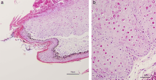 Figure 2.  (Colour online) 2a: Proliferative skin lesion with hyperkeratosis. Biopsy from the foot of Case A. Haematoxylin and eosin stained section. 2b: Higher power version of (2a) illustrating numerous large intracytoplasmic eosinophilic inclusions within hypertrophied epidermal cells.