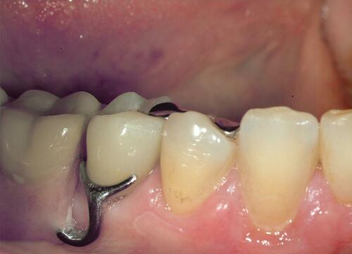 Figure 13 Intraoral final photography with a removable partial prosthetic.