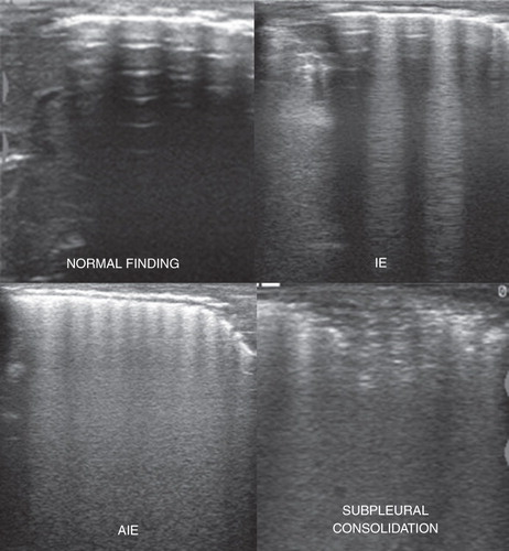 Figure 5. Four basic patterns of the lung US findings (IE = interstitial edema; AIE = alveolar-interstitial edema).