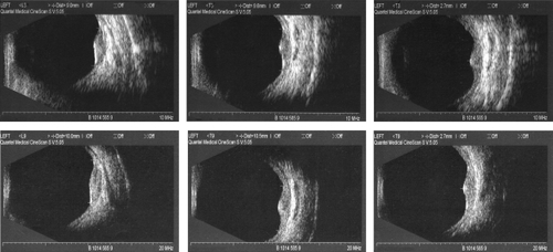 Figure 1 Ultrasound images of small ocular melanoma (82-year-old female, no previous treatment). Images display measurements of longitudinal and transversal diameter and tumor height (from left to right). Upper images show measurements with the 10 mHz B scan ultrasound transducer, lower images show the corresponding measurements with the 20 mHz B scan transducer.