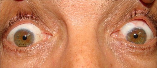 Figure 11 Patient with bilateral functioning blebs. The right eye of group A (mitomycin C and bevacizumab) and the left eye of group B (mitomycin C only).