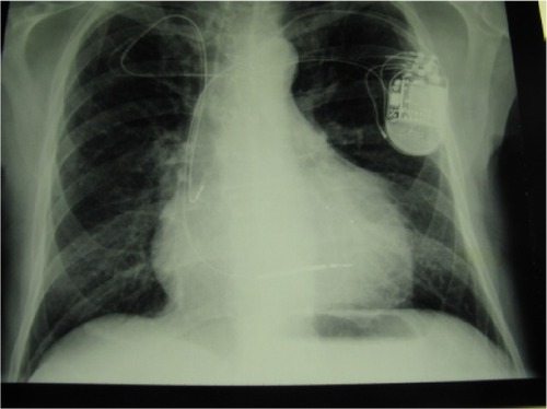 Figure 8 Pacemaker biventricular-bicameral/implantable cardiac defibrillator.