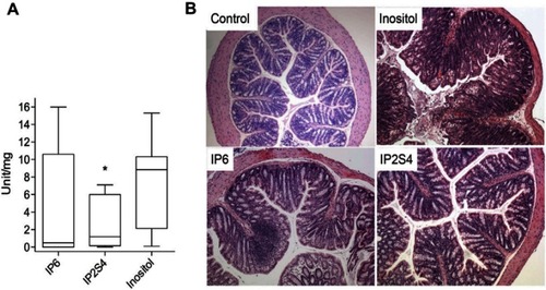 Figure 4 Swiss mice infected with fecal slur from a patient with recurrent Clostridium difficile infection. (A) Oral administration of IP2S4 but not IP6 significantly reduced the acute inflammatory component of colitis compared with administration of myo-inositol. (B) Histological sections of excised colons. Inositol-treated mice (negative control) displayed overt colonic structural changes characterized by mucosal ulceration and overlying exudate, marked acute and chronic inflammatory infiltrate and submucosal edema. IP2S4- and IP6-treated mice had decreased mucosal damage and inflammatory infiltrate. Copyright ©2018. Reproduced with permission from Elsevier. Ivarsson ME, Durantie E, Huberli C, et al. Small-molecule allosteric triggers of Clostridium difficile toxin B auto-proteolysis as a AQ3 therapeutic strategy. Cell Chem Biol. 2018;26(1):17–26.e13.Citation175
