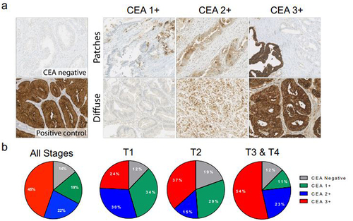 Figure 1. CEA expression in GBC tumor biopsies.