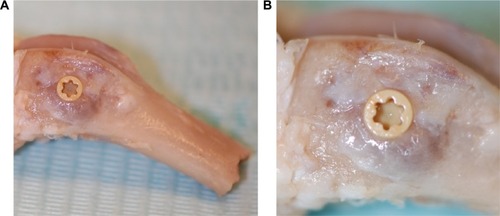 Figure 2 Clinical images of bone block (A) after retrieval demonstrating implant positioning and (B) with a magnified image of the implant in situ.