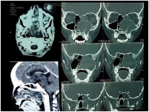 Figure 2. Pre-operative CT PNS.