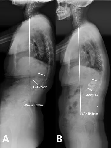 Figure 2. Case 1. A 74-years old female patient complained refractory low back pain after lumbar sprain 90 days ago. A: Preoperative full-length spine X-ray of the same patient show local kyphosis angle is 24.1°, the sagittal vertical axis(SVA) is -29.9 mm B: at the last follow up(35 months after operation), full-length spine X-ray show local kyphosis angle is 11.9°, the sagittal vertical axis(SVA) is 19.8 mm, the cement keeps in the original place.