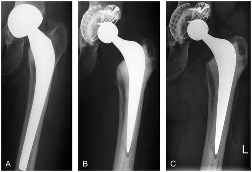 Figure 3. A. A 43-year-old woman at presentation with a loose cemented hemiarthroplasty with protrusion of the head. B. Directly after the conversion to a total hip arthroplasty (the acetabulum was reconstructed with metal meshes and bone impaction bone). C. 11 years postoperatively, showing a stable femoral and acetabular component without any signs of loosening.