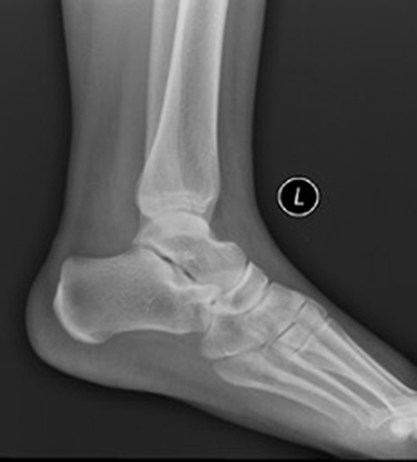 Figure 3 Ankle X-ray (lateral view). No abnormality found on plain X-ray.
