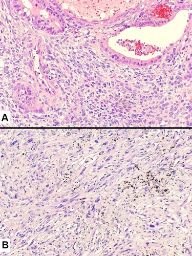 Figure 6 Histology of pleomorphic carcinoma revealing an adenocarcinoma (at the top) intermingled with neoplastic spindle cell component (A). Pure spindle cell carcinoma (B) consisting of a dense and irregular proliferation of atypical spindle cells with marked nuclear atypia and eosinophilic cytoplasm.