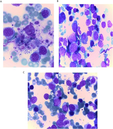 Figure 1. Features of dysplasia and blast cells in COVID-19 infected Acute myeloid leukemia (A): Hemophagocytic features (B): Blast cells with dysplastic features in myeloid and erythroid series (C) Reduction of blasts count after recovery from COVID-19 with eminent features of dysplasia in myeloid and erythroid series.