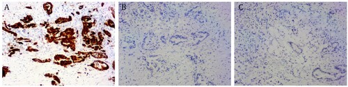 Figure 2. Photomicrographs (×100). Immunohistochemical stains of pancreatic tissue showed that cancer cells were strongly positive for CK-7 (A) but negative for CK-20 (B) and CDX2 (C).