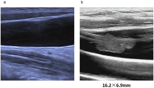 Figure 1 Ultrasound images of right internal jugular veins. (A) Before TIVAD implantation and (B) before TIVAD removal with chemotherapy completed in a breast cancer patient. Size of catheter-related thrombosis was listed at the bottom of the image.