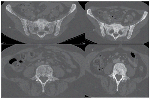 Figure 3. Stability with major osteosclerotic component of bone lesions before and after treatment (A B) and (C, D)