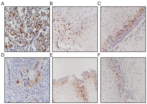 Figure 1 Immunohistochemistry analysis of expression of cyclins D1a and D1b. (A\D) Cervical cancer with positive expression of cyclins D1a and D1b (original magnification, ×200); (B\E) cervical intraepithelial neoplasia with positive expression of cyclins D1a and D1b (original magnification, ×200); (C\F) normal tissue with positive expression of cyclins D1a and D1b (original magnification, ×200).