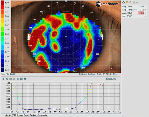 Figure 13 Tear film surface quality (TFSQ) over a scleral lens. The auto tear break-up time (TBUT) values on the top right of the screen are highlighted in red, indicating a critical dry surface condition.